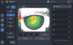 Оптический биометр и роговичный топограф HBM-1 Huvitz