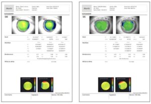 Роговичный топограф с анализом сухого глаза HTG-1 Huvitz