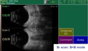 Ультразвуковой офтальмологический сканер Echoson PIROP