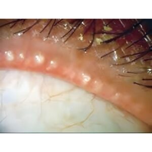 IPL система OptiLight Lumenis