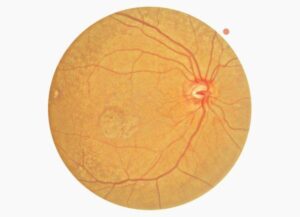 Немидриатичная фундус камера HFC-1 Huvitz