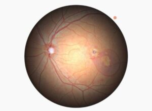 Немидриатичная фундус камера HFC-1 Huvitz