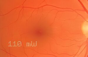 Система паттерн сканирования Array LaserLink Lumenis