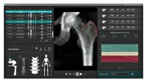 Денситометр рентгеновский полноформатный костный Density PB Eurotec Medical System